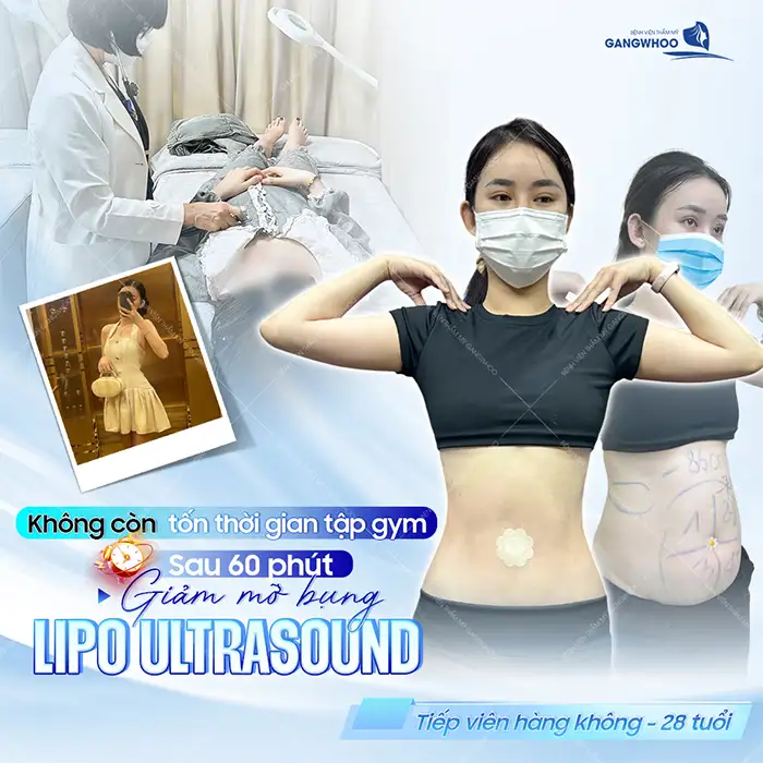 Top công nghệ hút mỡ hiện đại nhất hiện nay là gì? Nên lựa chọn công nghệ nào?