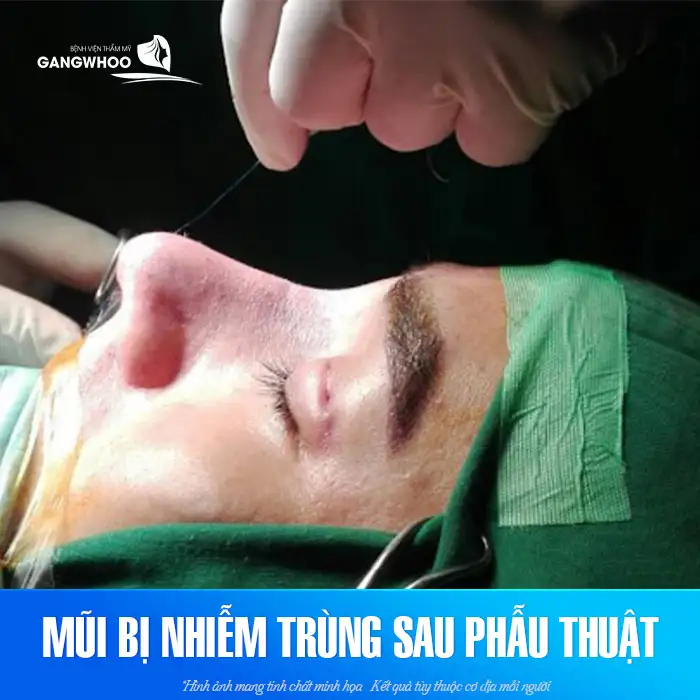 Dấu hiệu nhiễm trùng sau khi nâng mũi và cách xử lý hiệu quả