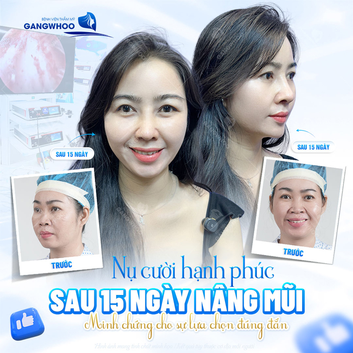 Gò má cao nó nên nâng mũi không? Tư vấn dáng mũi cho người gò má cao