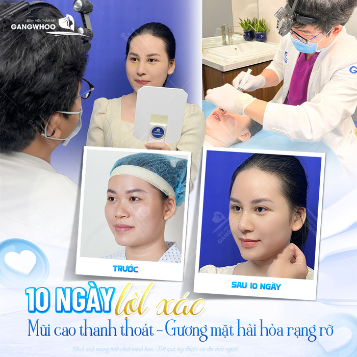 Gò má cao nó nên nâng mũi không? Tư vấn dáng mũi cho người gò má cao