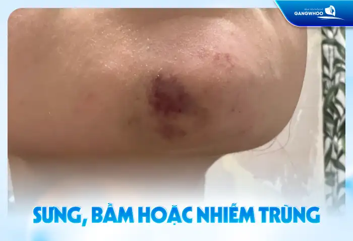 Gọt hàm có đau không? Có gây ra biến chứng gì không?