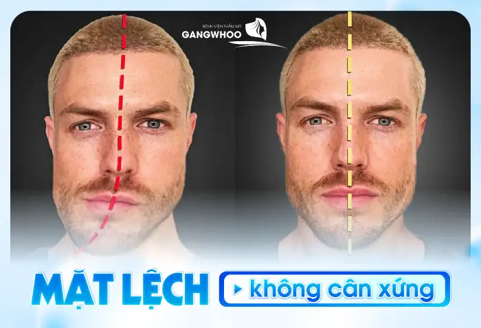 Gọt hàm có nguy hiểm không? Có nên thực hiện gọt hàm hay không?