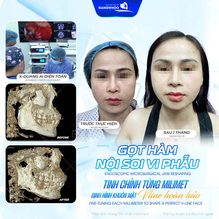 Gọt hàm giá bao nhiêu? Cập nhật chi phí gọt hàm mới nhất 2025