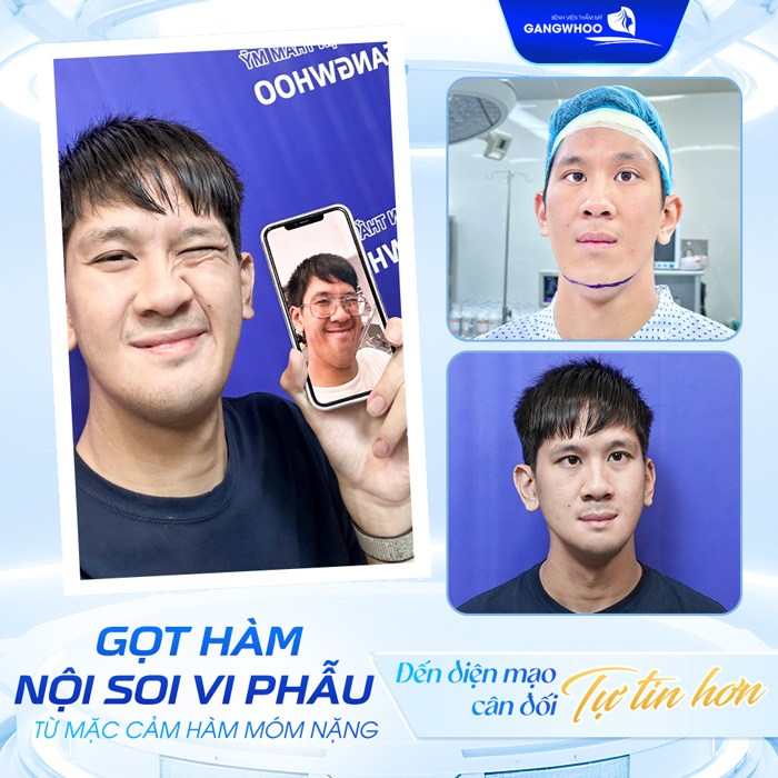 Gọt hàm giá bao nhiêu? Cập nhật chi phí gọt hàm mới nhất 2025