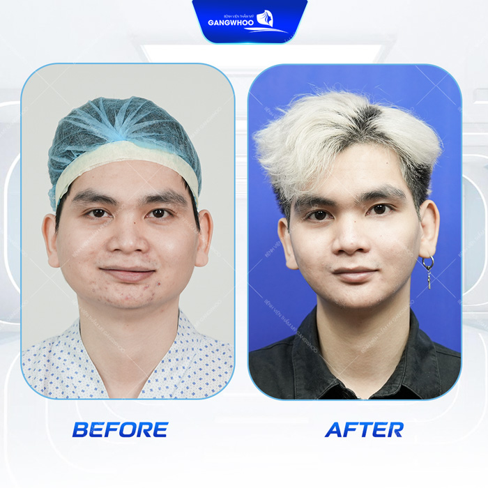 Gọt hàm giá bao nhiêu? Cập nhật chi phí gọt hàm mới nhất 2025