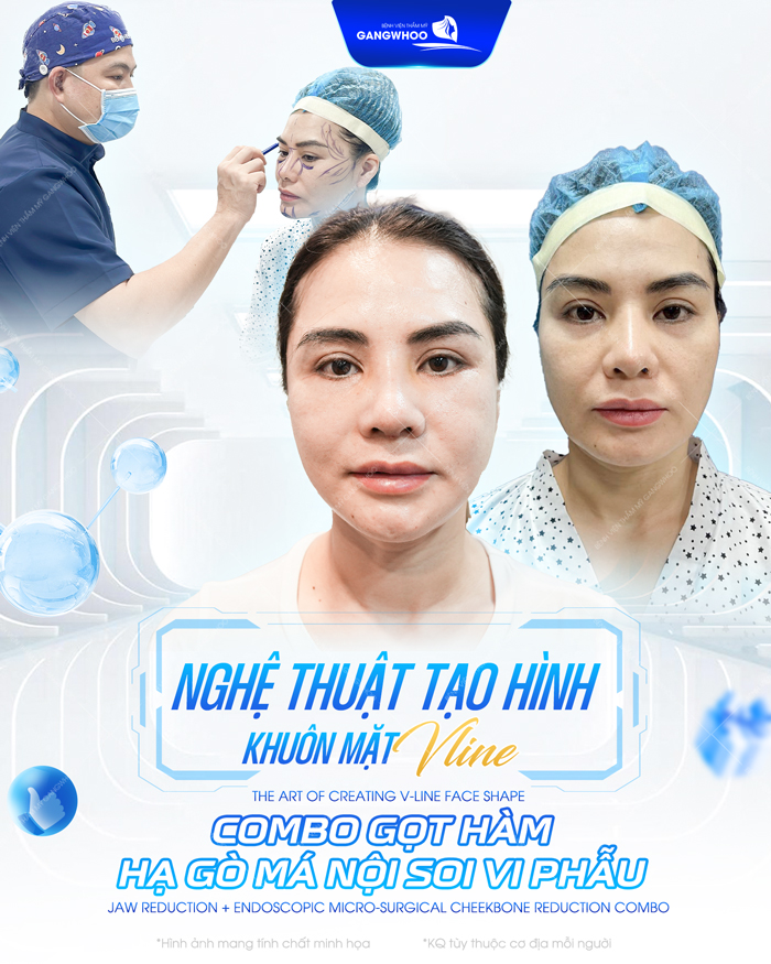 Phương pháp gọt hàm hạ gò má là gì? Ưu, nhược điểm như thế nào?