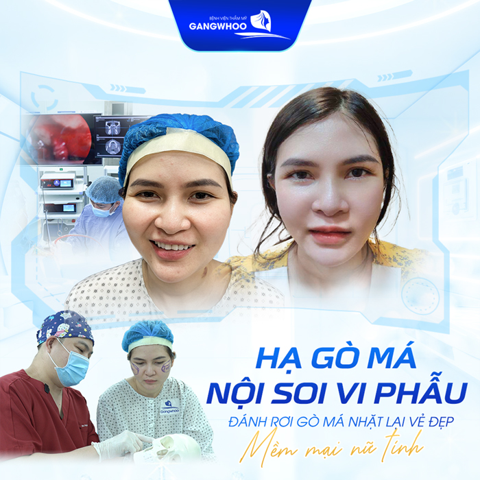 Hạ gò má bao lâu thì được nhai và ăn uống bình thường trở lại?