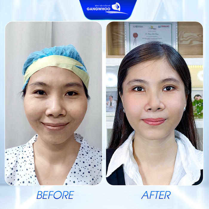 Hạ gò má bao lâu thì được nhai và ăn uống bình thường trở lại?