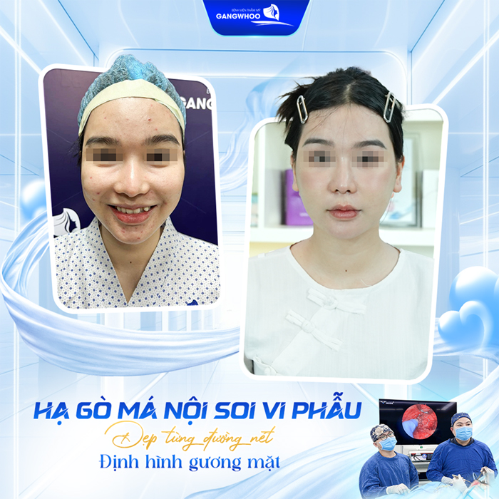 Hạ gò má bao lâu thì được nhai và ăn uống bình thường trở lại?