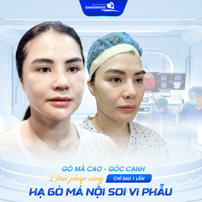 Hạ gò má bao lâu thì lành? Các giai đoạn hồi phục sau khi hạ gò má