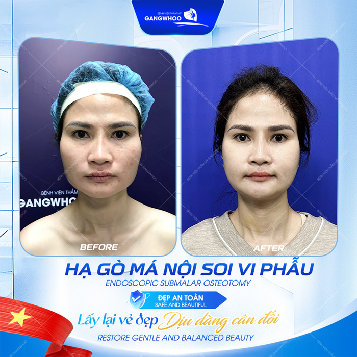 Hạ gò má bao lâu thì lành? Các giai đoạn hồi phục sau khi hạ gò má
