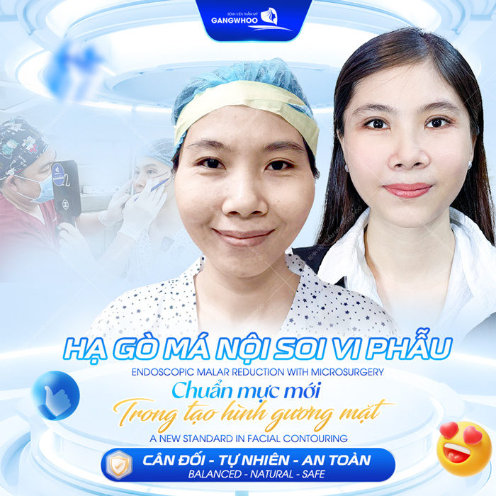 Hạ gò má bao lâu thì lành? Các giai đoạn hồi phục sau khi hạ gò má