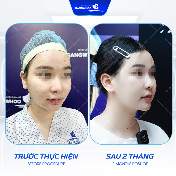 Hạ gò má bao lâu thì lành? Các giai đoạn hồi phục sau khi hạ gò má