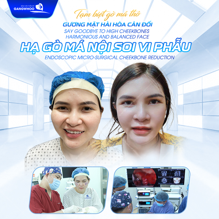 Hạ gò má bao lâu thì lành? Các giai đoạn hồi phục sau khi hạ gò má