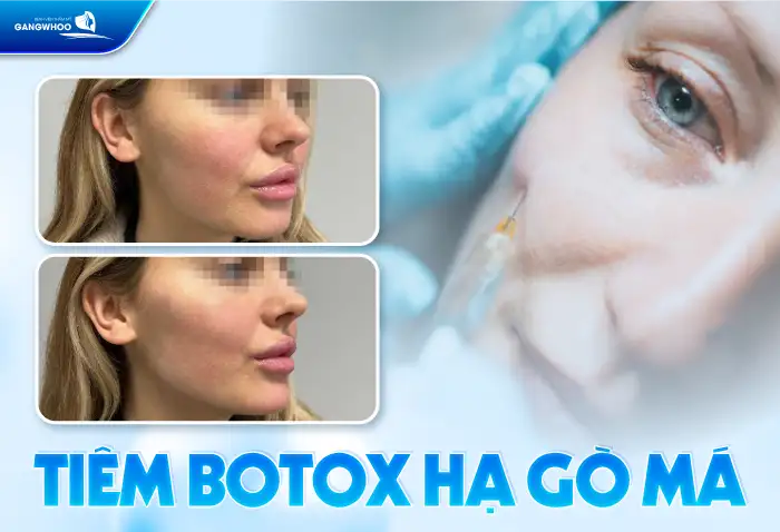 Hạ gò má không cần phẫu thuật có phương pháp nào? Có giữ được lâu không?