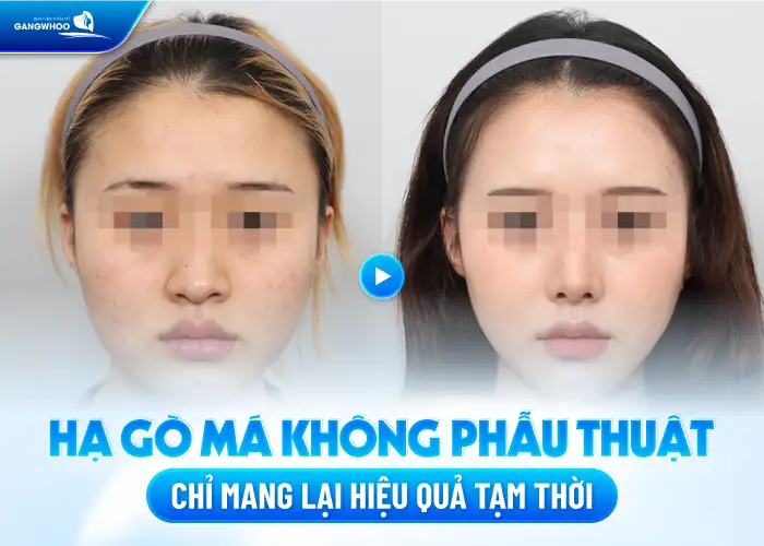 Hạ gò má không cần phẫu thuật có phương pháp nào? Có giữ được lâu không?
