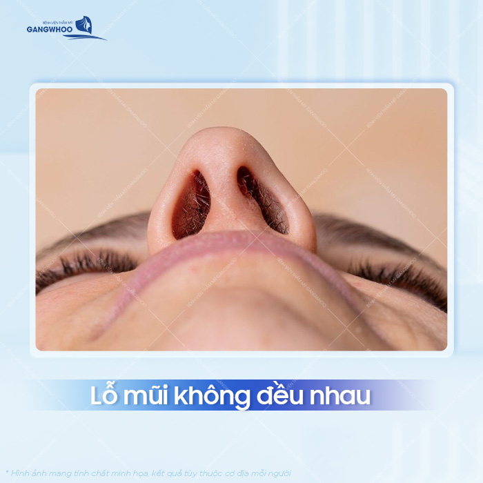 Tại sao hai lỗ mũi không đều sau khi nâng? Cách xử lý như thế nào?