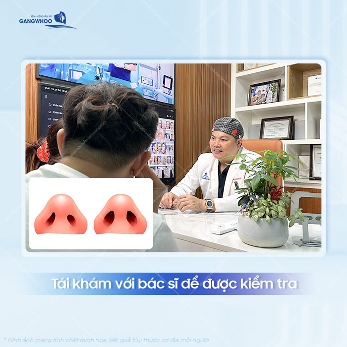 Tại sao hai lỗ mũi không đều sau khi nâng? Cách xử lý như thế nào?