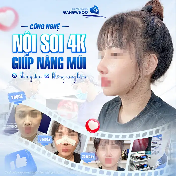 Hậu quả nâng mũi S Line có thễ gặp phải là gì? Cần lưu ý gì?