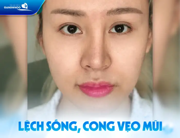 Hậu quả nâng mũi S Line có thễ gặp phải là gì? Cần lưu ý gì?