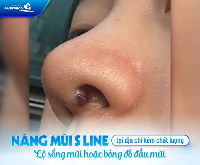 Hậu quả nâng mũi S Line có thễ gặp phải là gì? Cần lưu ý gì?