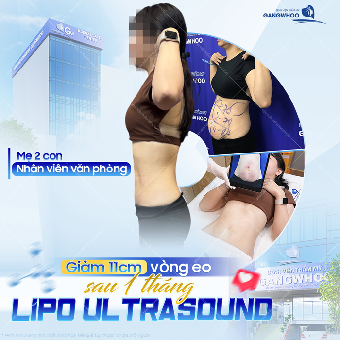 Hiệu quả hút mỡ bụng kéo dài được bao lâu? Cách duy trì độ hiệu quả lâu dài