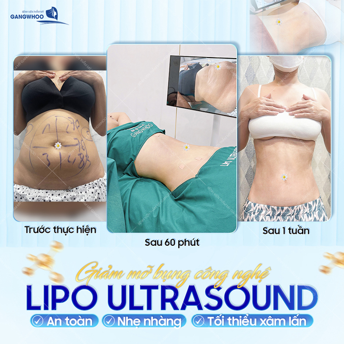 Hút mỡ bụng có đau không? Công nghệ nào hút mỡ bụng không đau?