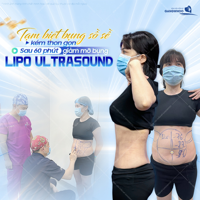 Hút mỡ bụng có đau không? Công nghệ nào hút mỡ bụng không đau?