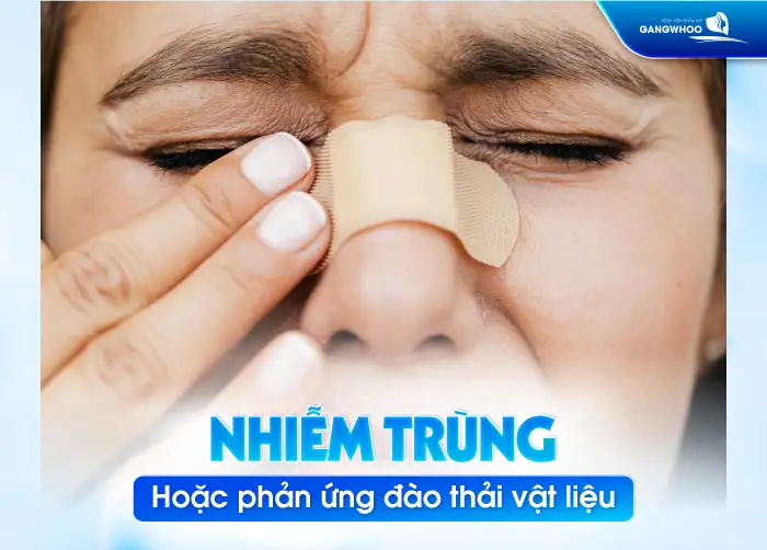 Tại sao mũi bị lung lay sau nâng mũi? Cách xử lý như thế nào?