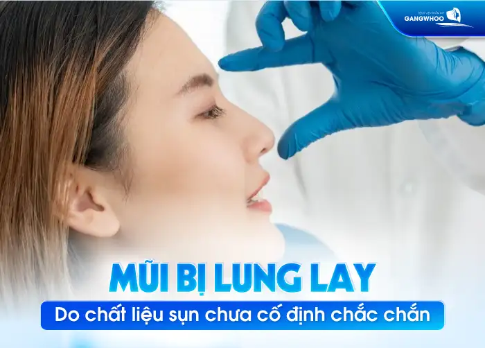Tại sao mũi bị lung lay sau nâng mũi? Cách xử lý như thế nào?