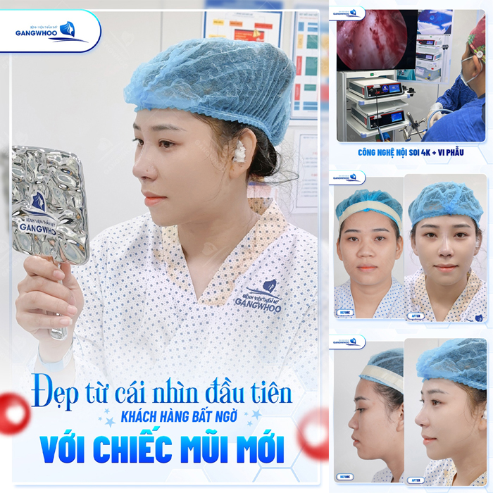 Mũi tẹt và hếch nên nâng kiểu nào? Dáng mũi nào phù hợp?