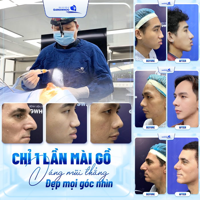 Phương pháp nắn chỉnh xương nâng mũi là gì? Phù hợp với những ai?