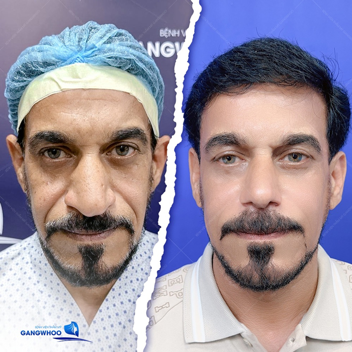 Phương pháp nắn chỉnh xương nâng mũi là gì? Phù hợp với những ai?