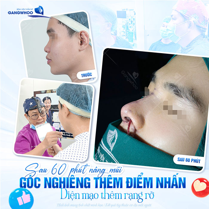 Nâng đầu mũi giá bao nhiêu? Cập nhật giá nâng đầu mũi mới nhất 2025