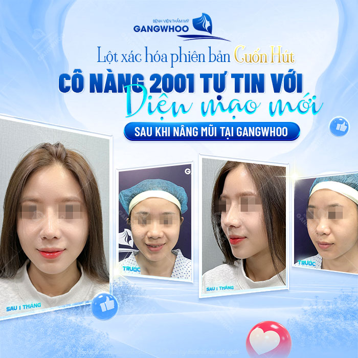 Nâng đầu mũi giá bao nhiêu? Cập nhật giá nâng đầu mũi mới nhất 2025