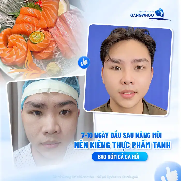 Sau nâng mũi có được ăn bún không? Có ảnh hưởng đến vết thương không?