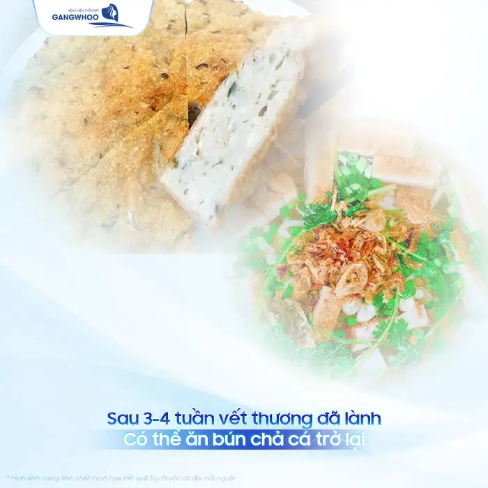 Nâng mũi ăn bún chả cá được không? Có gây ra biến chứng?