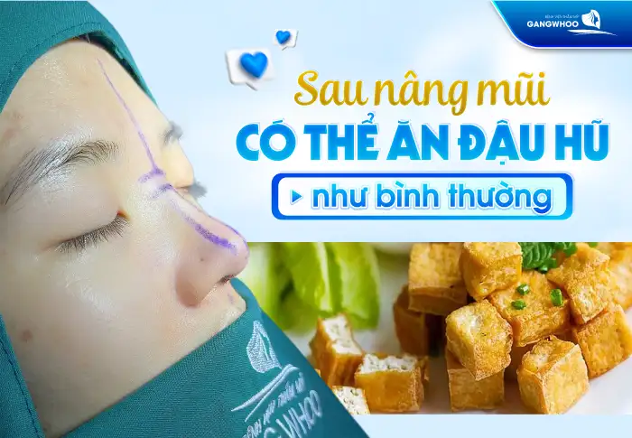 Nâng mũi ăn đậu hũ được không? Có gây nên sẹo sau khi nâng mũi không?