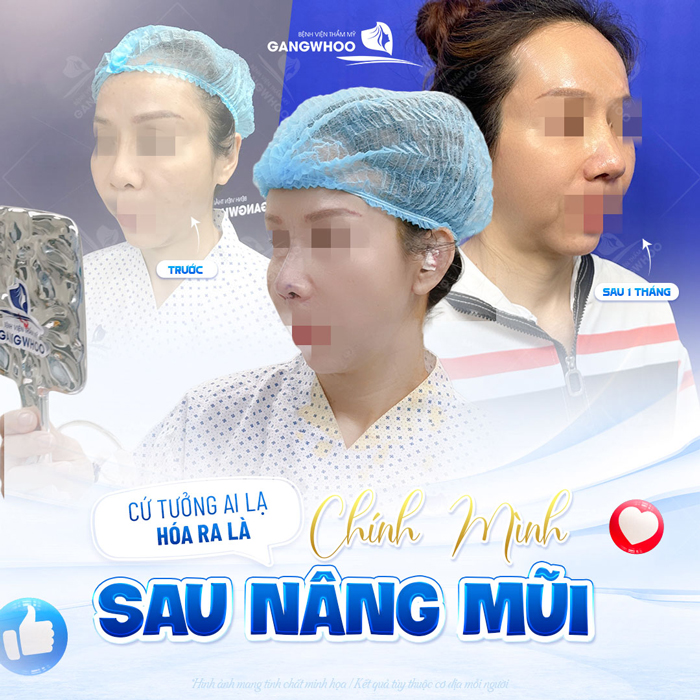 Nâng mũi bằng chỉ Ultra V Lift là gì? Ưu, nhược điểm của phương pháp