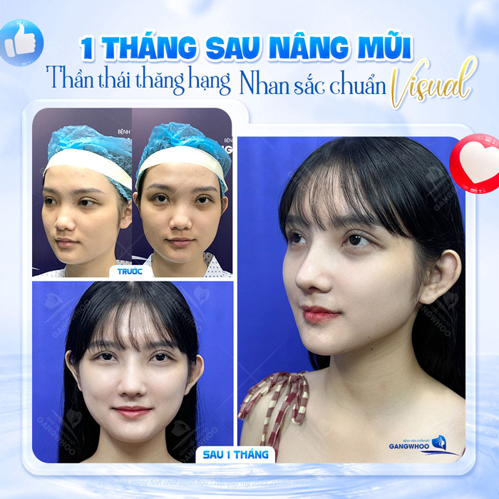 Nâng mũi bằng chỉ Ultra V Lift là gì? Ưu, nhược điểm của phương pháp