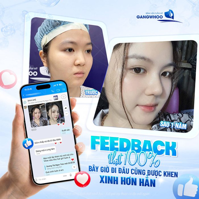 Nâng mũi bằng chỉ Ultra V Lift là gì? Ưu, nhược điểm của phương pháp