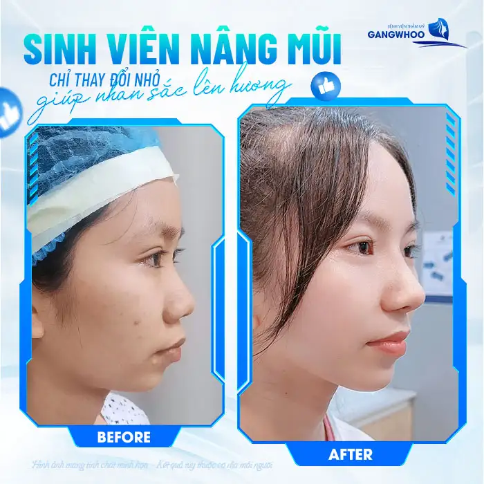 Nâng mũi bằng trung bì mỡ là gì? Ưu, nhược điểm của phương pháp này là gì?