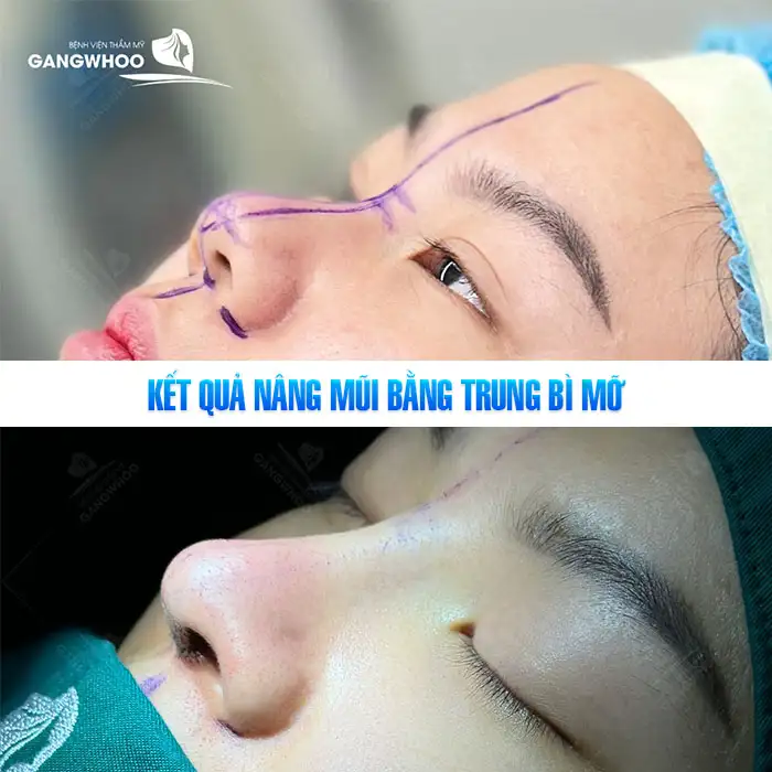 Nâng mũi bằng trung bì mỡ là gì? Ưu, nhược điểm của phương pháp này là gì?