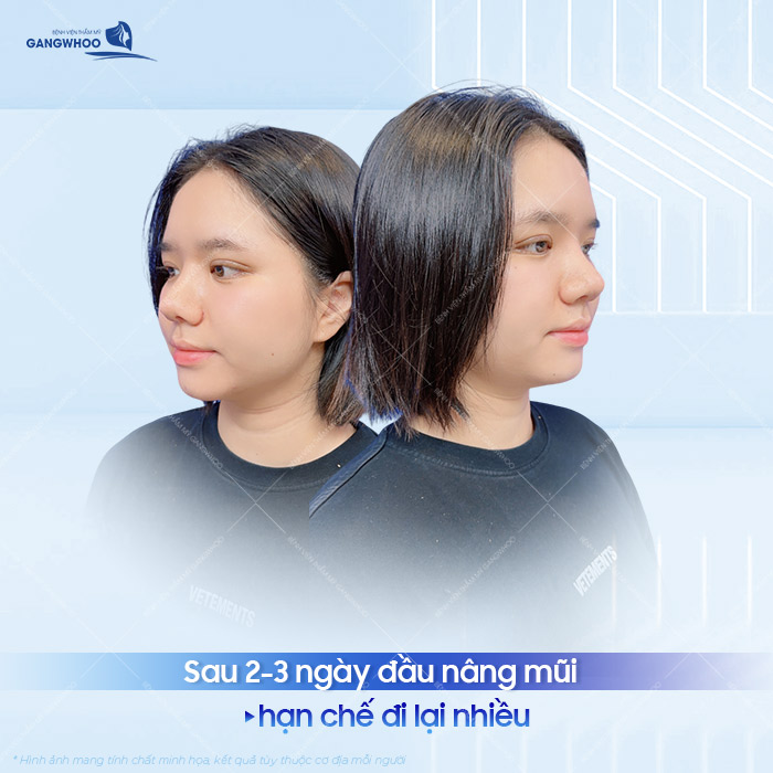 Nâng mũi bao lâu thì đi làm được? Cách chăm sóc mũi nhanh hồi phục?