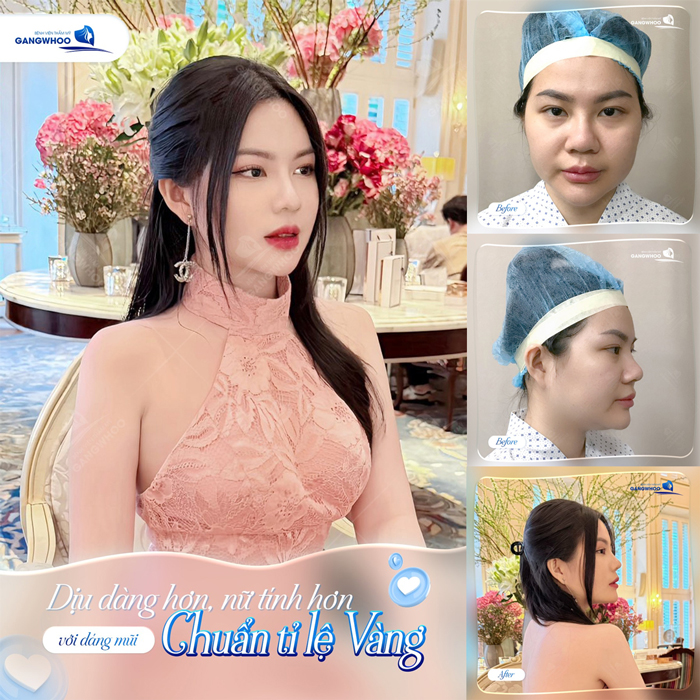 Nâng mũi Barbie Line là gì? Nên lựa chọn nâng mũi Barbie Line hay S-Line