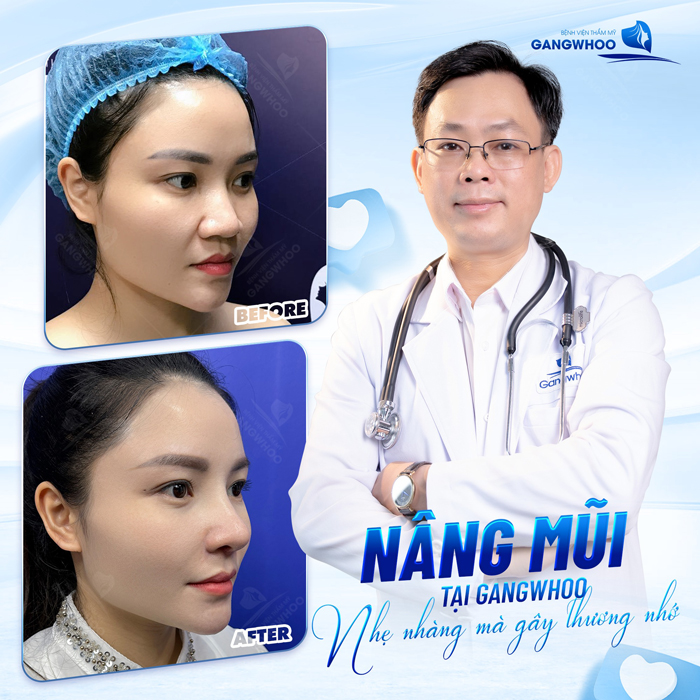 Nâng mũi Barbie Line là gì? Nên lựa chọn nâng mũi Barbie Line hay S-Line