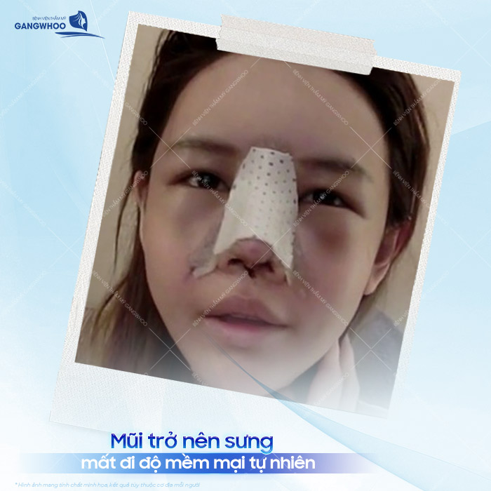 Nâng mũi bị bao xơ nguyên nhân do đâu? Cách xử lý mô xơ trên mũi? 2 Nâng mũi bị bao xơ nguyên nhân do đâu? Cách xử lý mô xơ trên mũi?