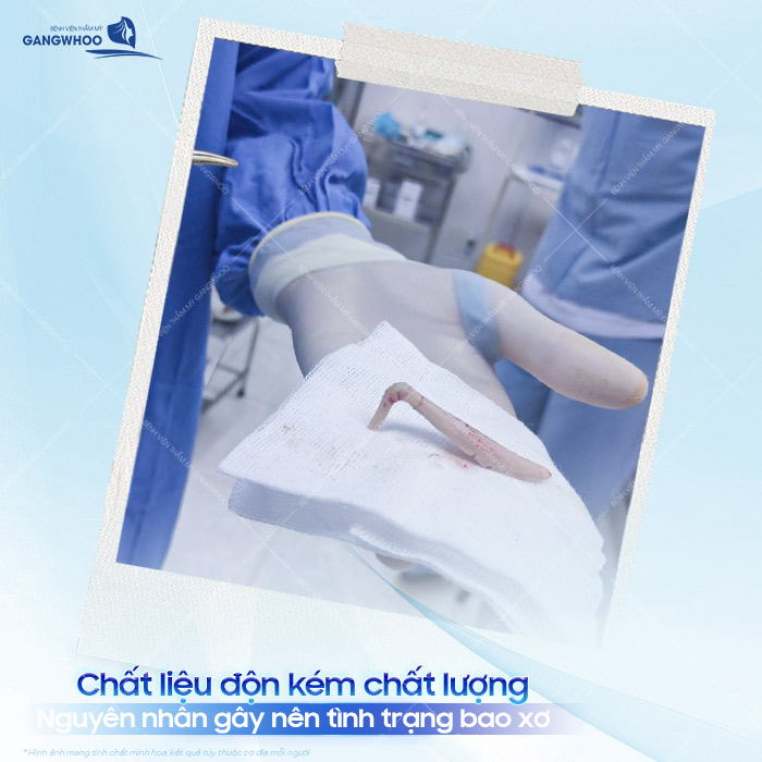 Nâng mũi bị bao xơ nguyên nhân do đâu? Cách xử lý mô xơ trên mũi? 1 Nâng mũi bị bao xơ nguyên nhân do đâu? Cách xử lý mô xơ trên mũi?