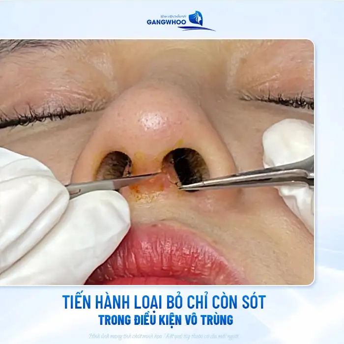 Nâng mũi bị cắt sót chỉ có sao không? Cách xử lý như thế nào?