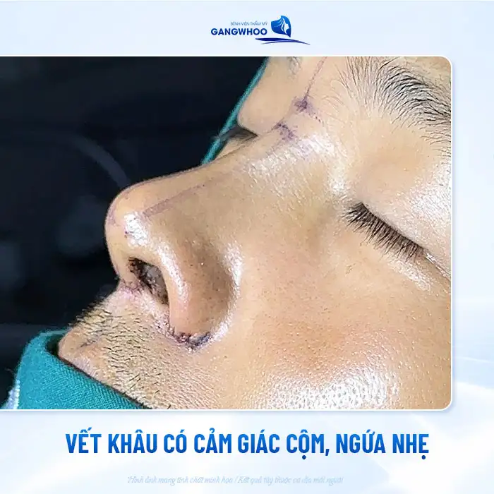 Nâng mũi bị cắt sót chỉ có sao không? Cách xử lý như thế nào?